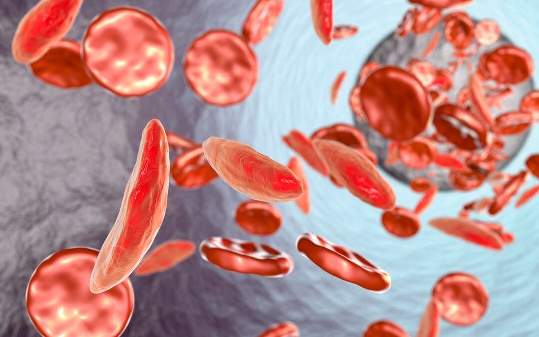 COVID-19, Sickle Cell Disease, and a Critical Need